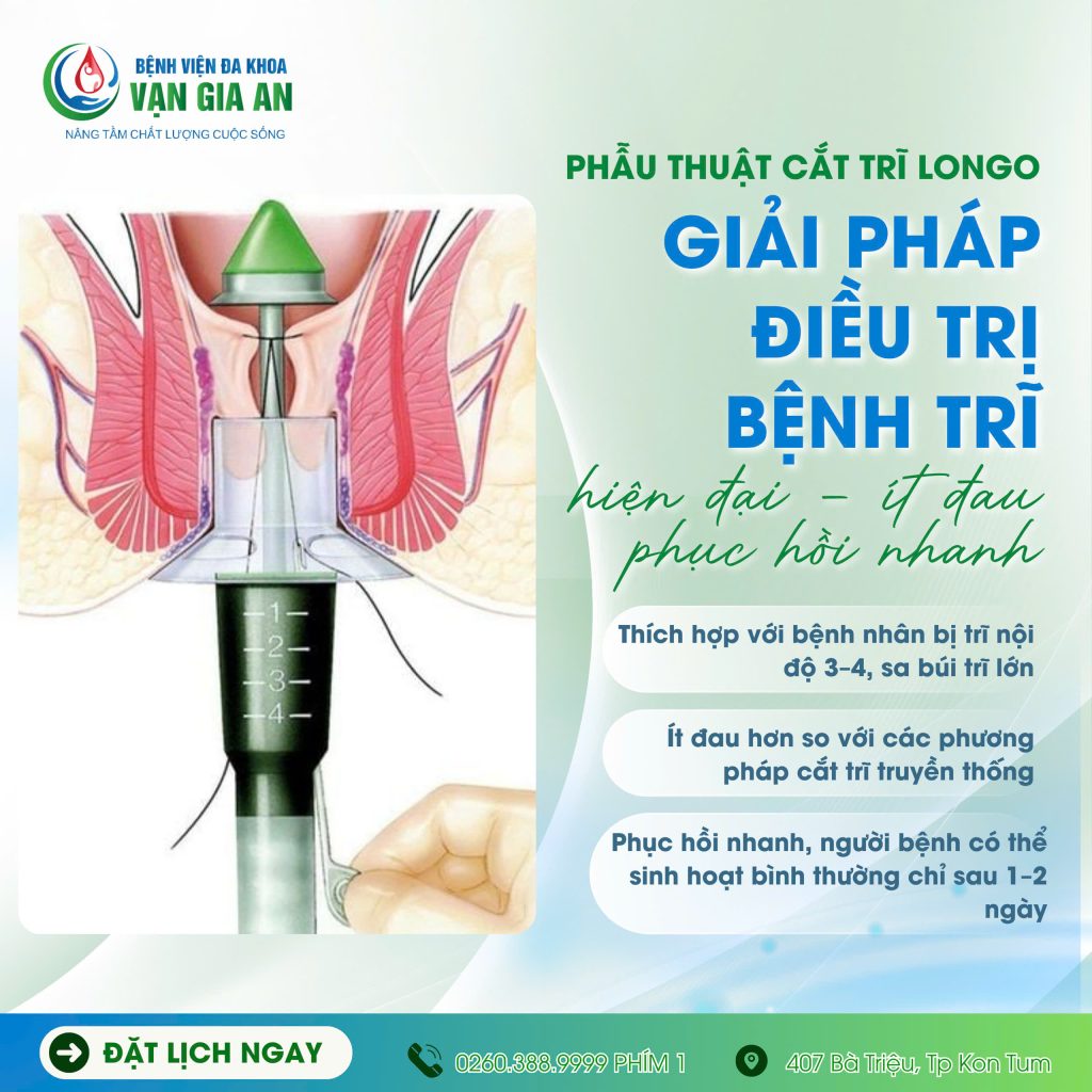 Điều trị bệnh trĩ bằng phương pháp Longo tại Bệnh viện Vạn Gia An - Ít đau, phục hồi nhanh